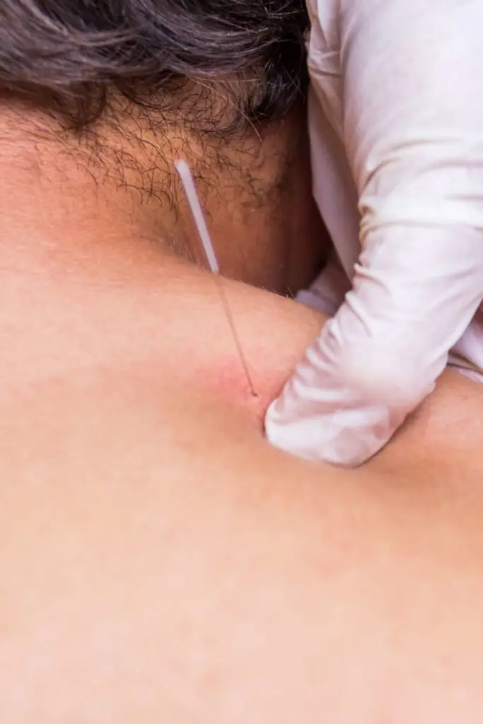 How does dry needling work with chronic muscle tightness?