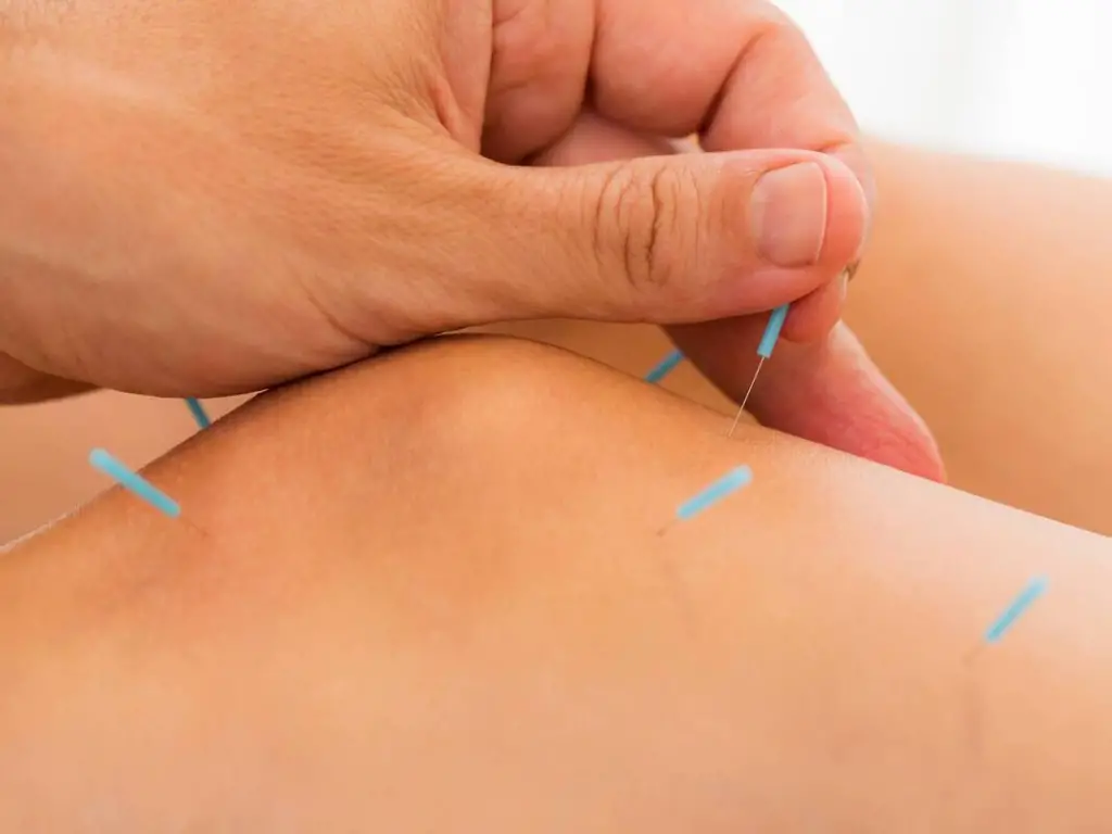 What is the difference between acupuncture and dry needling?