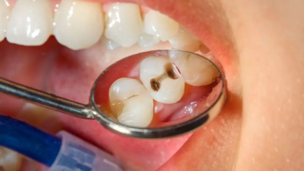 What Does A Cavity Feel Like 1 Cavity And What Are Its Causes