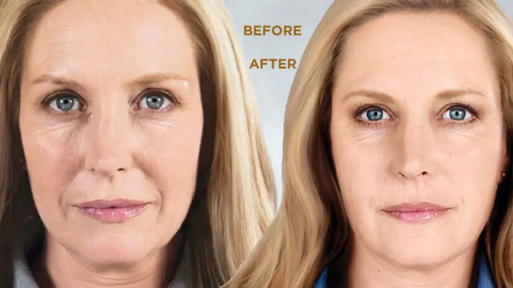 How Long Does Sculptra Last 1 Sculptra before after