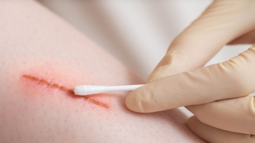 What Happens if You Leave a Wound Untreated 1 wound