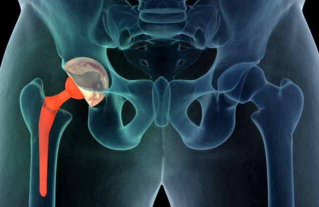 Hip replacement