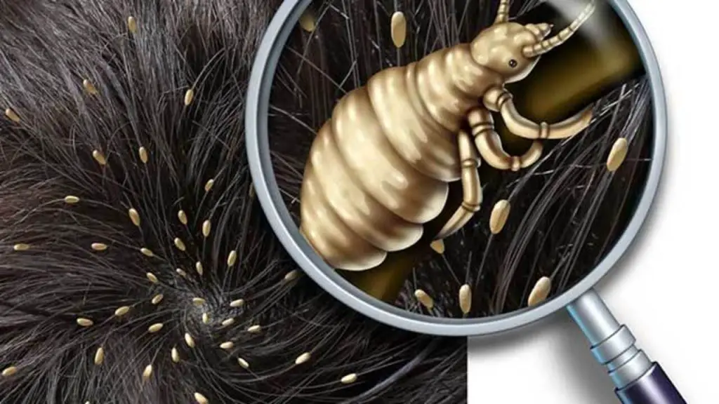 head lice