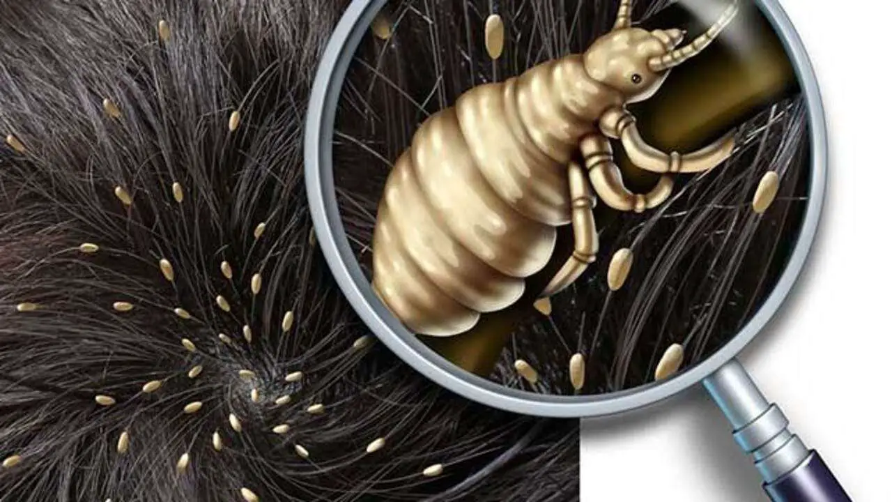 What Happens If You Have Head Lice for Too Long Launch Knowledge